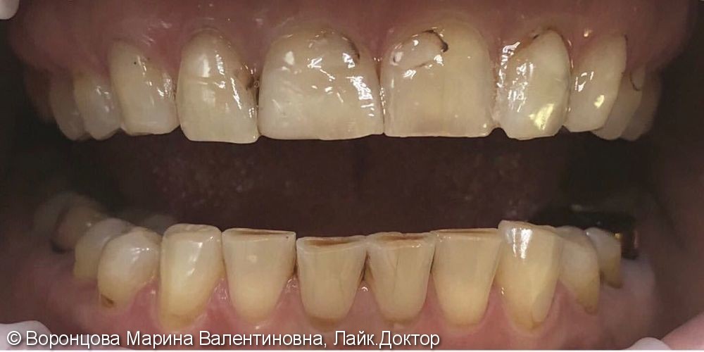 Художественная реставрация зубов! - фото №1