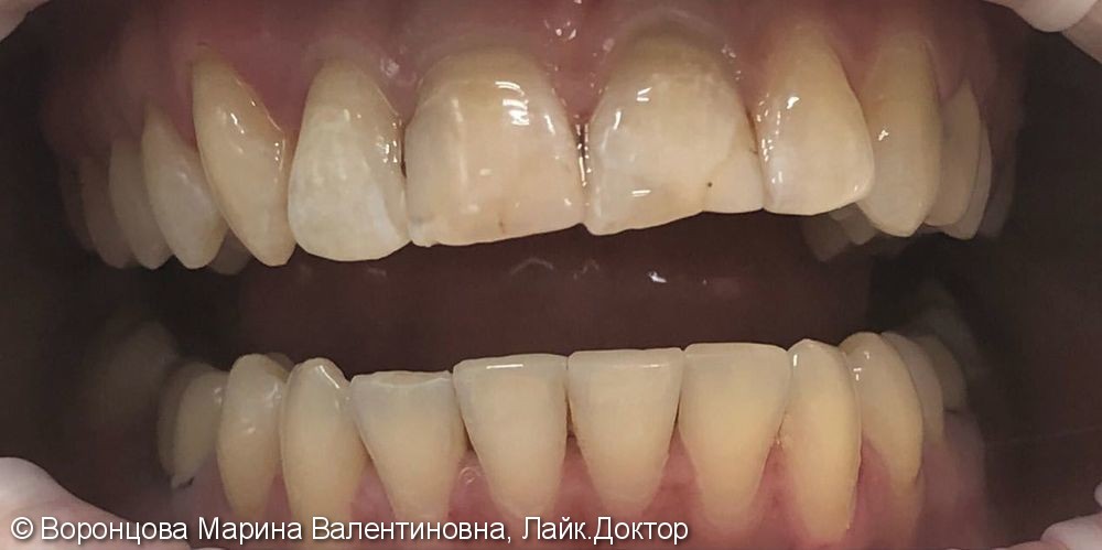 Коррекция длины и формы анатомической коронки зуба - фото №1