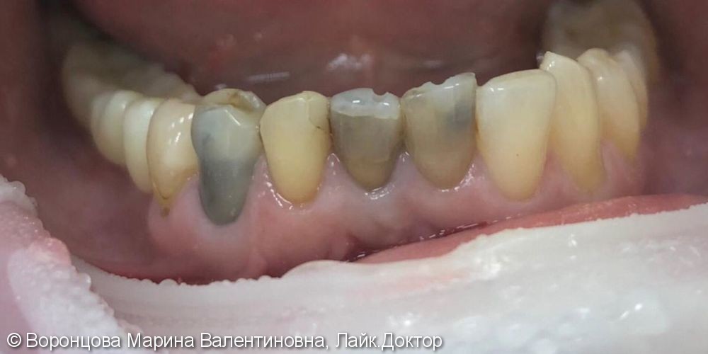 Эндодонтическое перелечивание трех зубов, до и после - фото №1