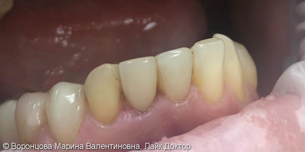 Эндодонтическое перелечивание трех зубов, до и после - фото №2