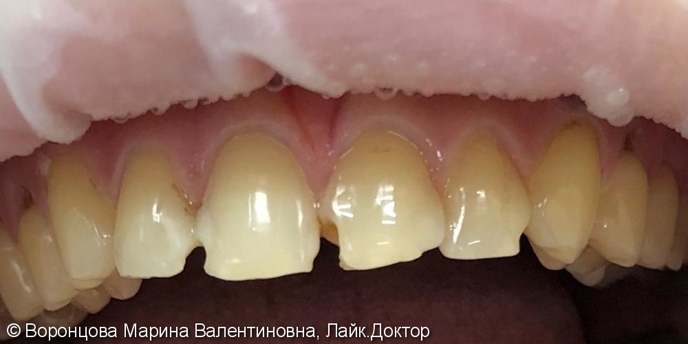 Художественная реставрация трех зубов материалом ESTELITE ASTERIA - фото №1