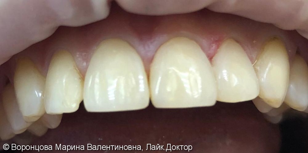 Художественная реставрация трех зубов материалом ESTELITE ASTERIA - фото №2