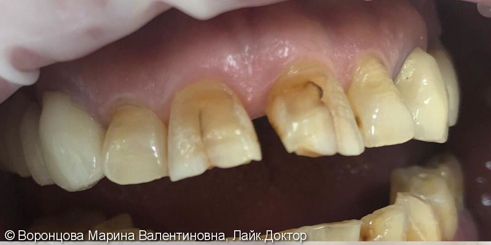 Художественная реставрация фронтальных зубов Estelite ASTERIA - фото №1