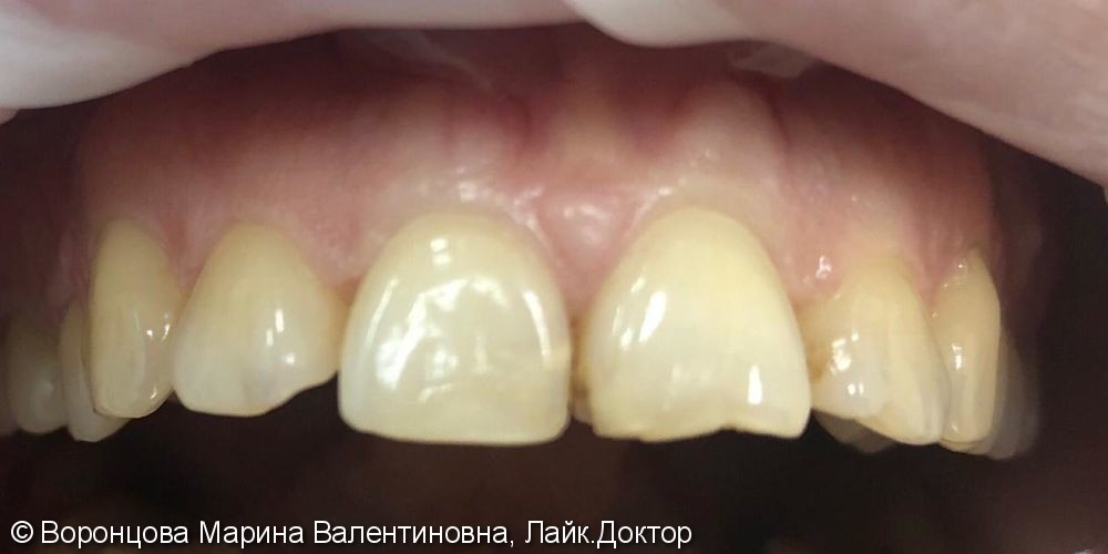 Художественная реставрация фронтальных зубов Estelite ASTERIA - фото №1