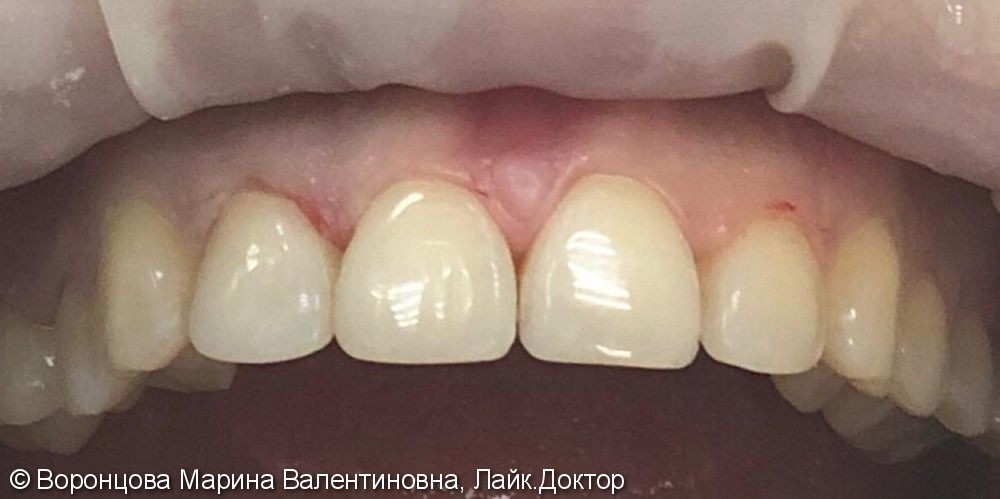 Художественная реставрация фронтальных зубов Estelite ASTERIA - фото №2