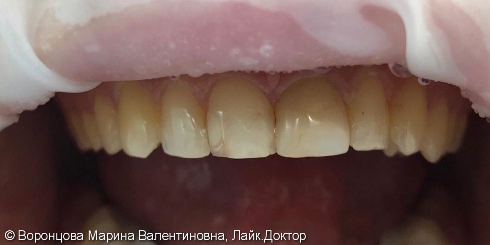 Косметический дефект 2-х центральных зубов - фото №1