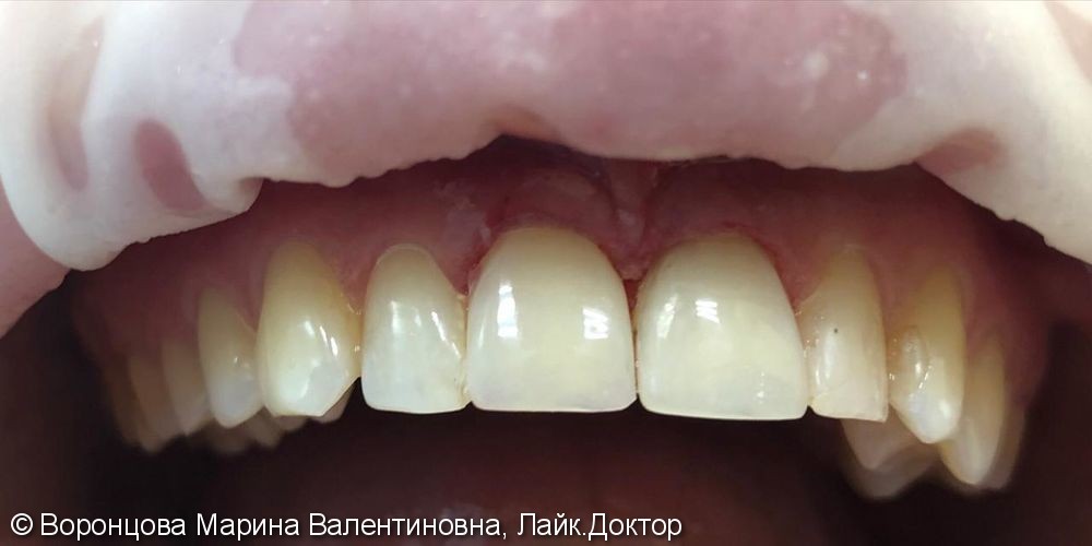 Косметический дефект 2-х центральных зубов - фото №2