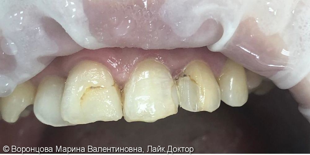 Художественная реставрация зубов нанокомпозитным материалом Estelite ASTERIA - фото №1