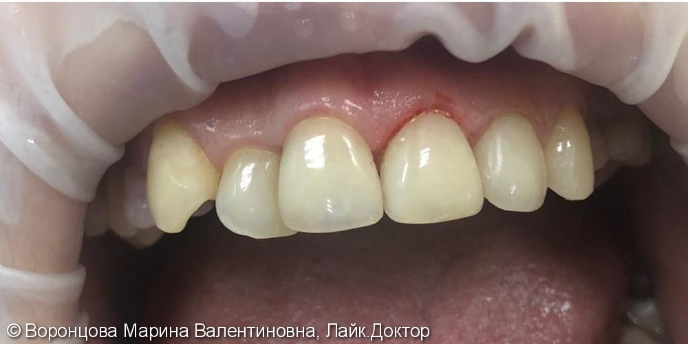 Художественная реставрация зубов нанокомпозитным материалом Estelite ASTERIA - фото №2