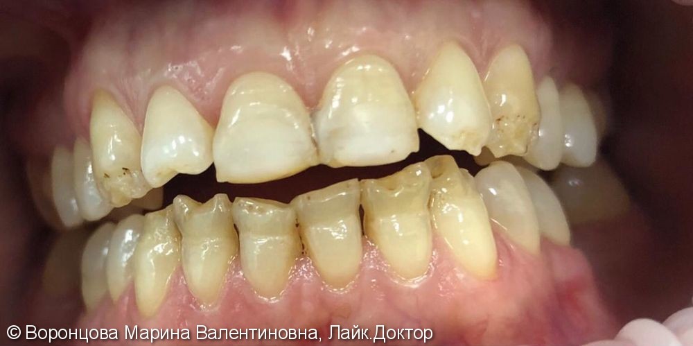 Художественная реставрация зубов + ВИНИРЫ из прессованой керамики Е-МАХ - фото №1