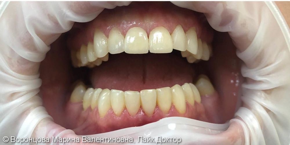 Художественная реставрация зубов + ВИНИРЫ из прессованой керамики Е-МАХ - фото №2
