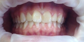 Исправление неровного положения зубов брекетами - фото №1