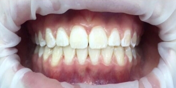 Исправление неровного положения зубов брекетами - фото №2