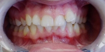 Скученное положение зубов верхней и нижней челюсти - фото №1