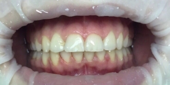 Скученное положение зубов верхней и нижней челюсти - фото №2