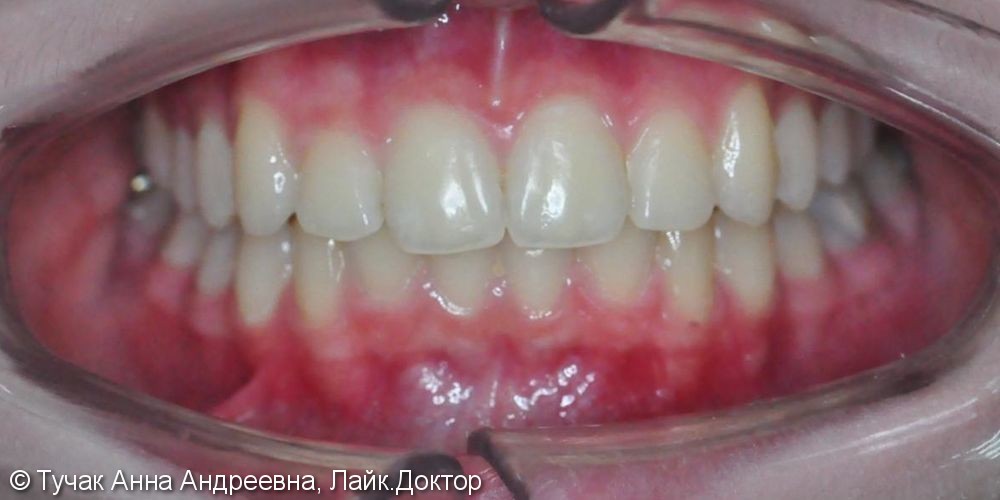 Исправить скученное положение зубов без удаления - фото №4