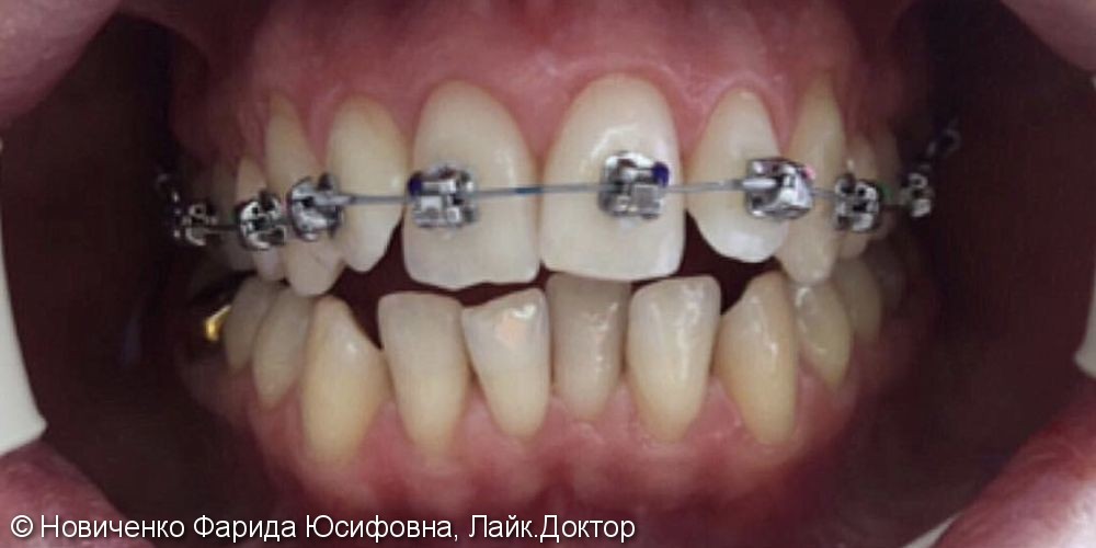 Ортодонтическое лечение: открытый прикус в сочетании с дистальной окклюзией - фото №1