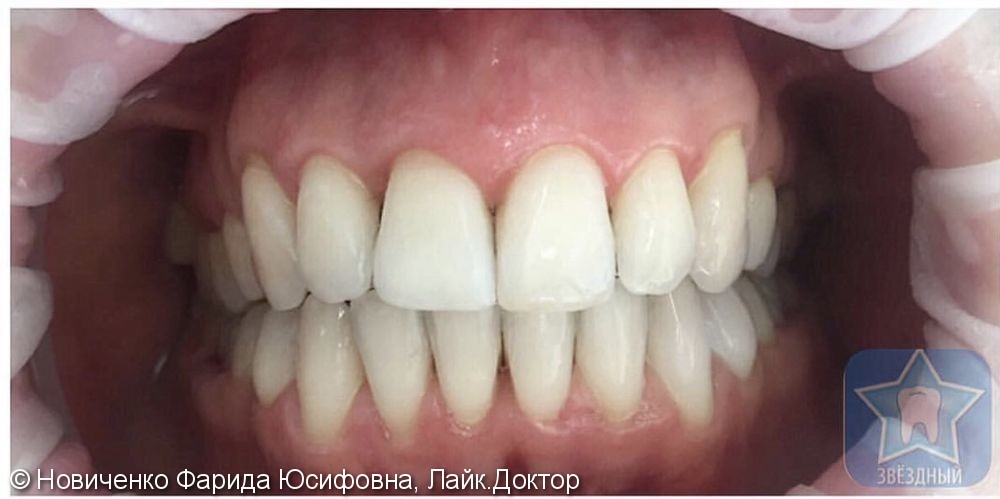 Ортодонтическое лечение: открытый прикус в сочетании с дистальной окклюзией - фото №2