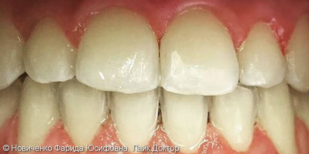 Ортодонтическое лечение без удаления при помощи брекет системы Damon Q - фото №2