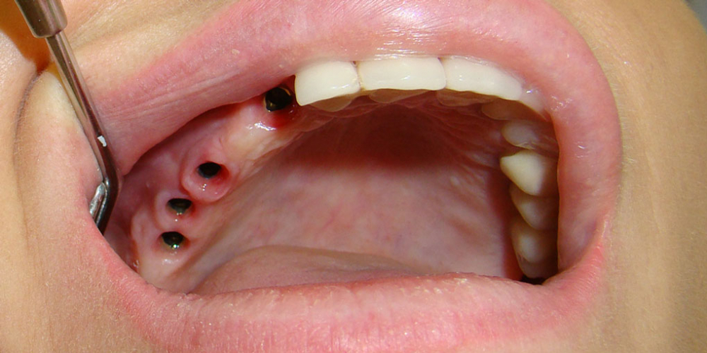 Результат восстановления зубов мостовидным протезом на имплантах - фото №1