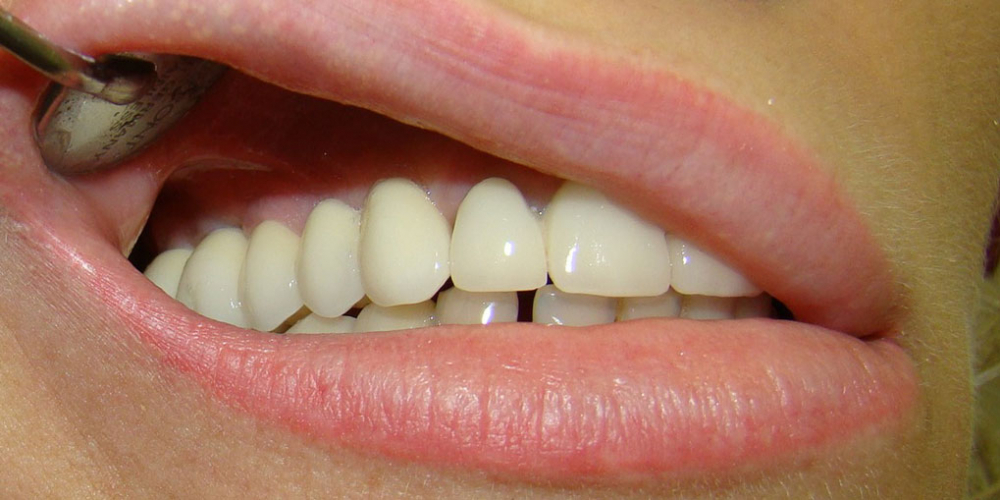 Результат восстановления зубов мостовидным протезом на имплантах - фото №4