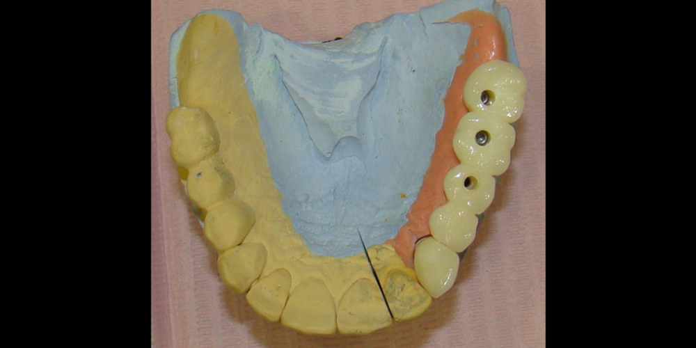 Результат восстановления зубов мостовидным протезом на имплантах - фото №3