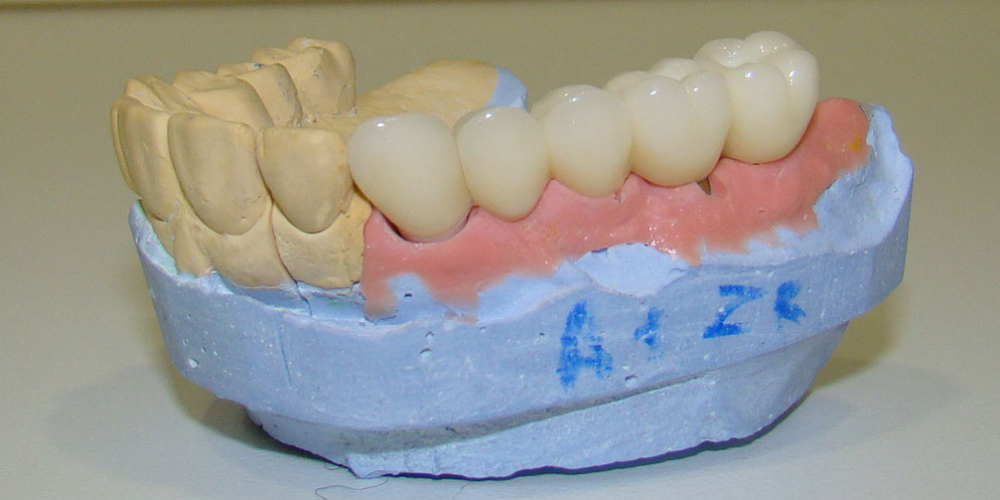 Результат восстановления зубов мостовидным протезом на имплантах - фото №2