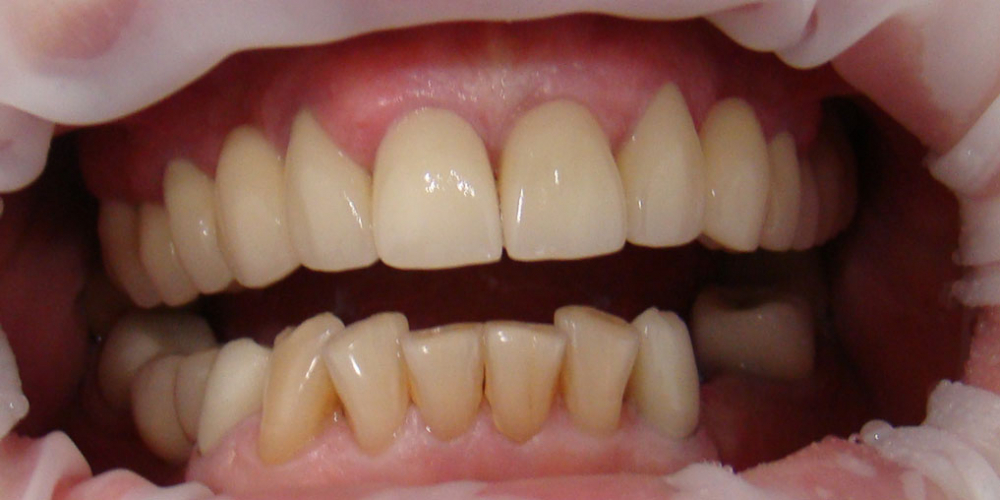 Протезирование передних зубов нижней челюсти винирами - фото №1