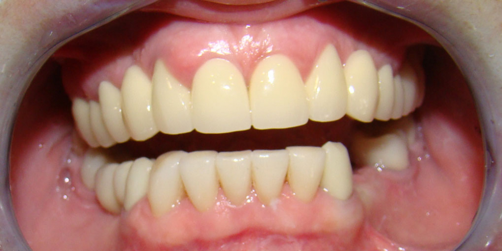 Протезирование передних зубов нижней челюсти винирами - фото №2