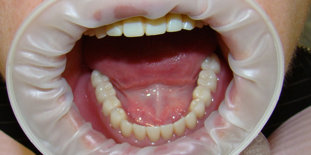 Протезирование нижней челюсти при полном отсутствии зубов имплантатами Nobel Procera - фото №5