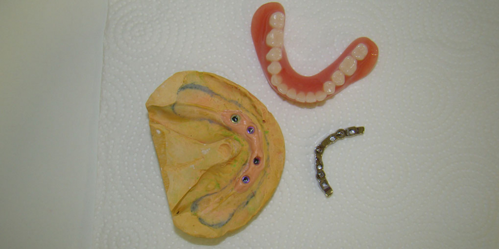 Протезирование нижней челюсти при полном отсутствии зубов имплантатами Nobel Procera - фото №3