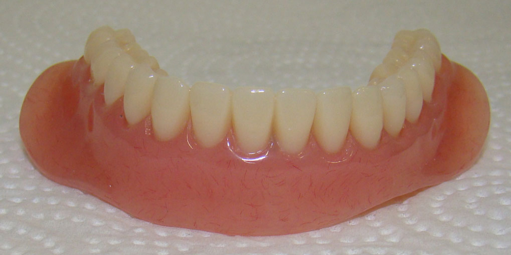 Протезирование нижней челюсти при полном отсутствии зубов имплантатами Nobel Procera - фото №4