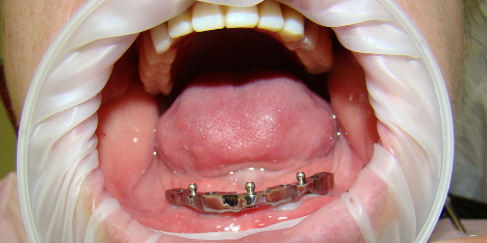 Протезирование нижней челюсти при полном отсутствии зубов имплантатами Nobel Procera - фото №2