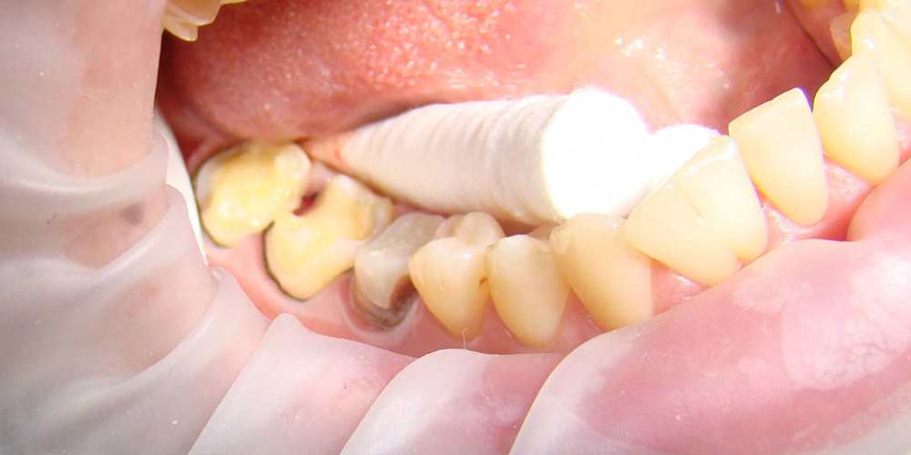 Восстановление коронковой части зубов цельнокерамическими вкладками E-max press - фото №1