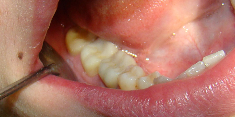 Восстановление коронковой части зубов цельнокерамическими вкладками E-max press - фото №3