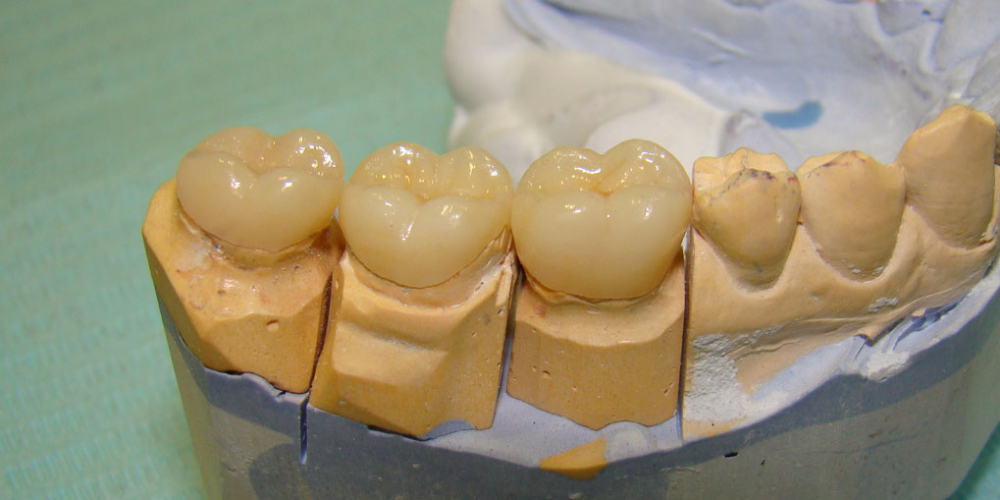 Восстановление коронковой части зубов цельнокерамическими вкладками E-max press - фото №2