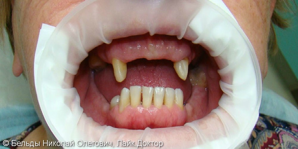 Восстановление жевательных функций зубов с помощью протезирования, до и после - фото №1