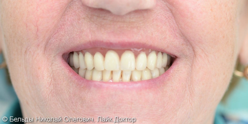 Восстановление жевательных функций зубов с помощью протезирования, до и после - фото №7