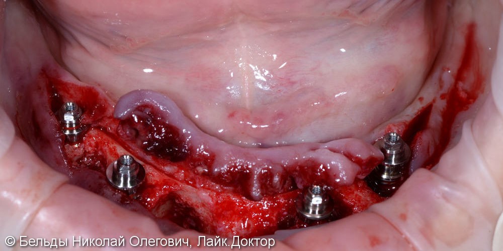 Имплантация All-on-4 на верхней и нижней челюсти, результат до и после - фото №2
