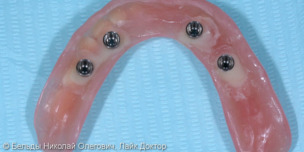 Имплантация All-on-4 на верхней и нижней челюсти, результат до и после - фото №5