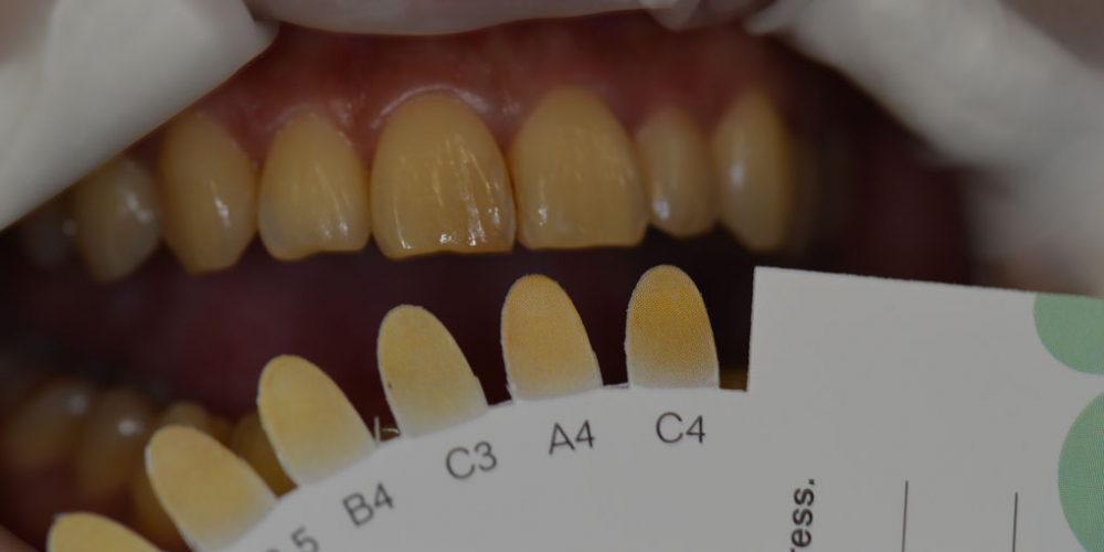 Результат отбеливания зубов Opalescence BOOST - фото №1