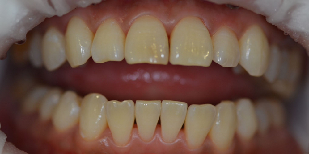 Результат отбеливания зубов Opalescence BOOST - фото №2