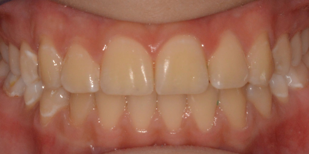 Исправление прикуса выпирающего зуба на верхней челюсти - фото №2