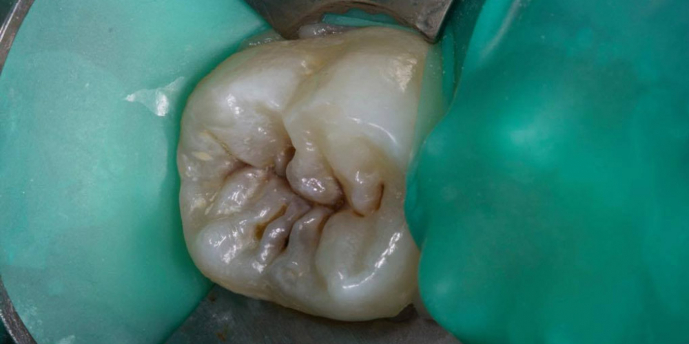 Результат лечения кариеса и реставрация жевательного зуба - фото №1