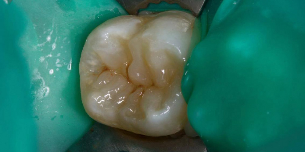 Результат лечения кариеса и реставрация жевательного зуба - фото №3