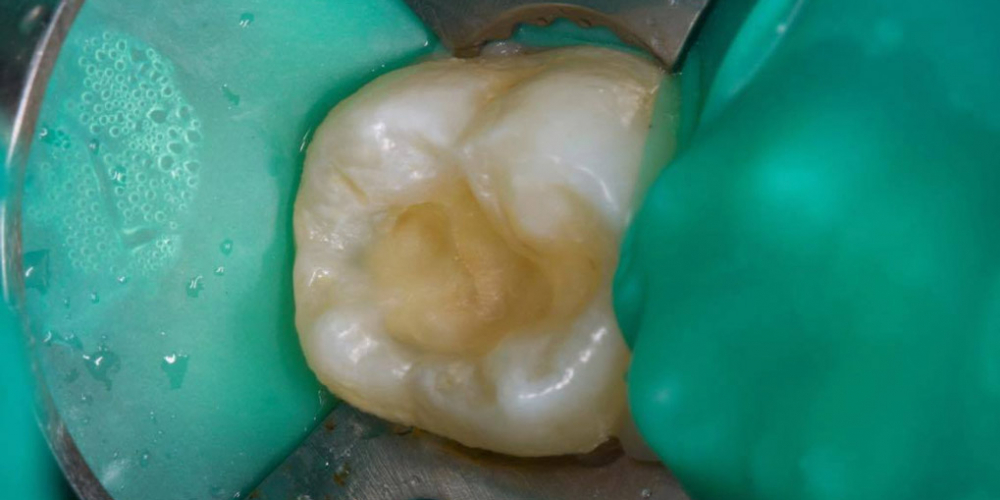 Результат лечения кариеса и реставрация жевательного зуба - фото №2