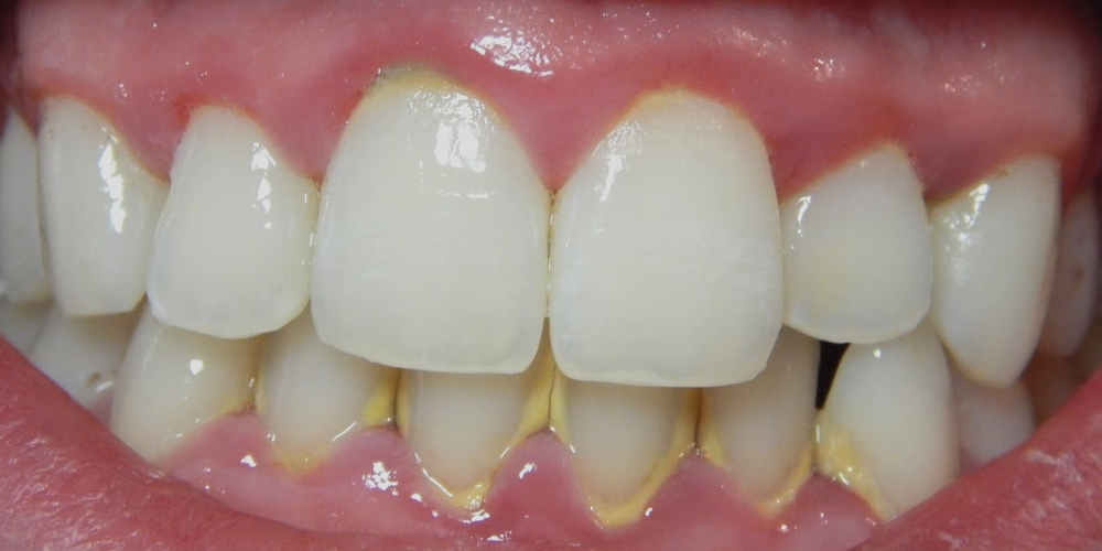 Результат лечения кариеса зубов - фото №1