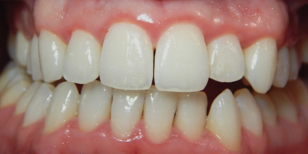 Результат лечения кариеса зубов - фото №2