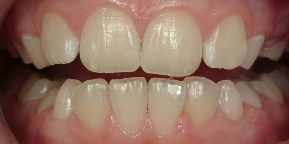 Гигиеническая чистка зубов - фото №3