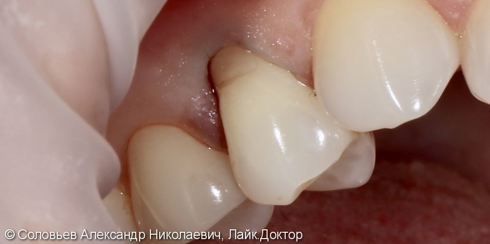 Лечение клиновидного дефекта 14 зуба - фото №1